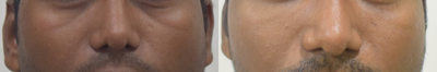 Dermal Fillers before and after photo