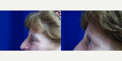 Eyelid Surgery before and after photo