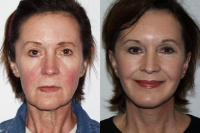 Facelift before and after photo