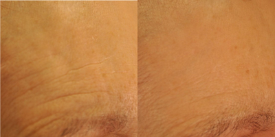 Microneedling before and after photo