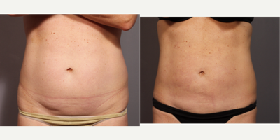 Smart Lipo before and after photo