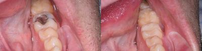 Tooth Repair before and after photo
