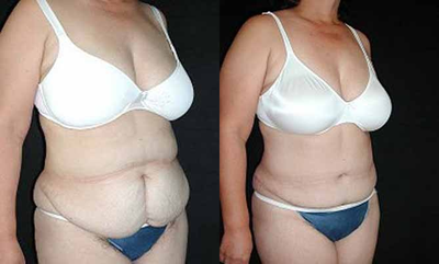 Tummy Tuck before and after photo