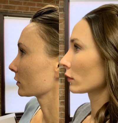 IPL before and after photo