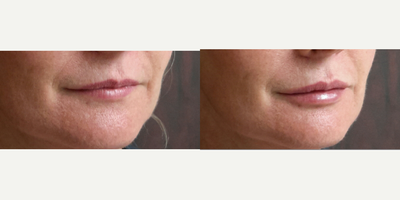 Lip Fillers before and after photo