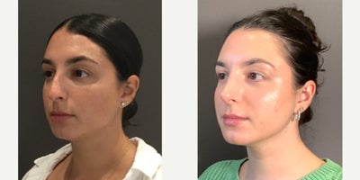 Rhinoplasty before and after photo
