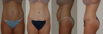 Tummy Tuck before and after photo