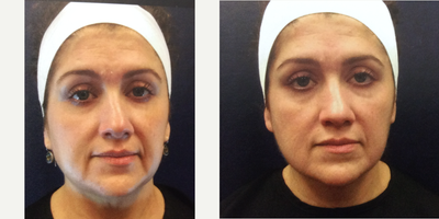 Ultherapy before and after photo