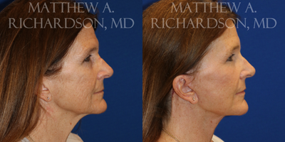 Eyelid Surgery before and after photo