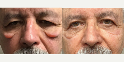 Eyelid Surgery before and after photo