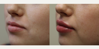Lip Fillers before and after photo