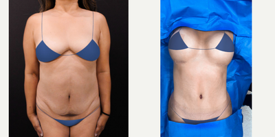 Liposuction before and after photo