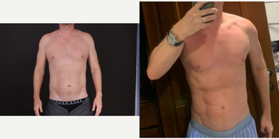 Abdominal Etching before and after photo
