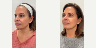 Agnes RF before and after photo