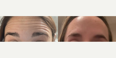 Botox before and after photo