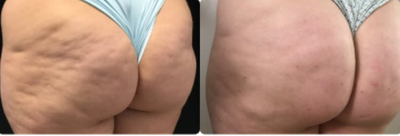 Cellfina before and after photo