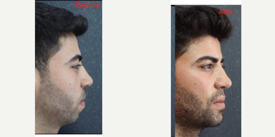 Chin Implant before and after photo