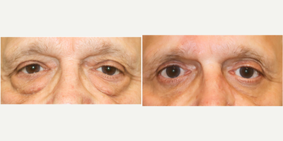 Eyelid Surgery before and after photo
