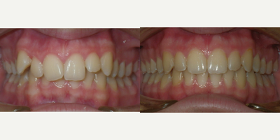 Invisalign before and after photo