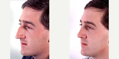 Nonsurgical Nose Job before and after photo