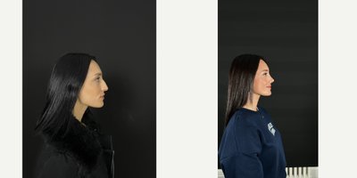 Rhinoplasty before and after photo