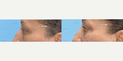 Eyelid Surgery before and after photo