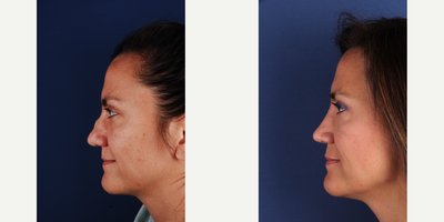 Revision Rhinoplasty before and after photo