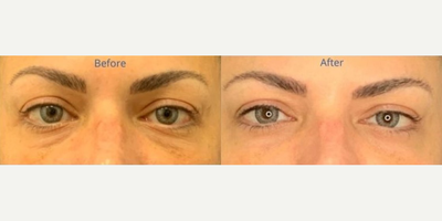 Skin Tightening before and after photo