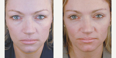 Brow Lift before and after photo
