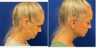 Facial Fat Transfer before and after photo