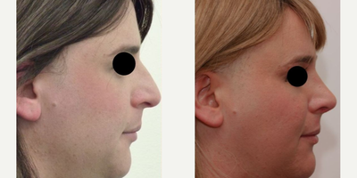 Facial Feminization Surgery before and after photo