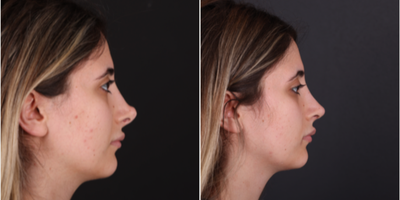 Revision Rhinoplasty before and after photo