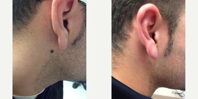 ActiveFX before and after photo