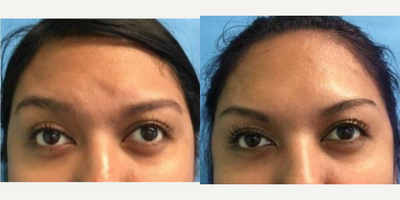 Botox before and after photo