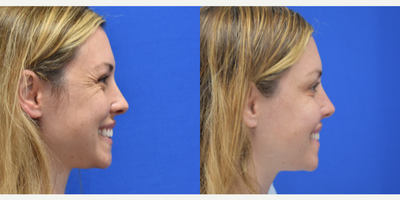 Botox before and after photo