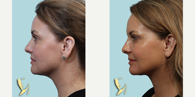 Facelift before and after photo