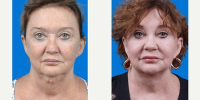 Neck Lift before and after photo