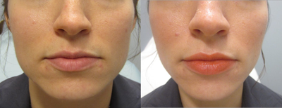 Volbella before and after photo