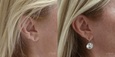 Dermal Fillers before and after photo