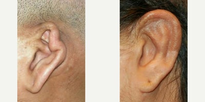 Ear Surgery before and after photo