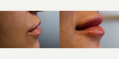 Juvederm before and after photo