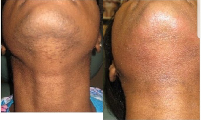 Laser Hair Removal before and after photo