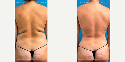 Liposuction before and after photo