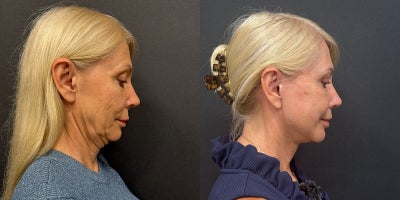 Neck Lift before and after photo