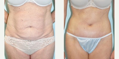 Tummy Tuck before and after photo