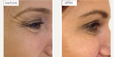 Botox before and after photo