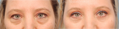 Eyelid Surgery before and after photo