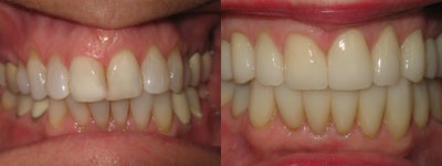 Smile Makeover before and after photo