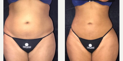 Tummy Tuck before and after photo