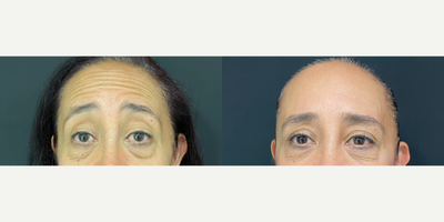 Botox before and after photo